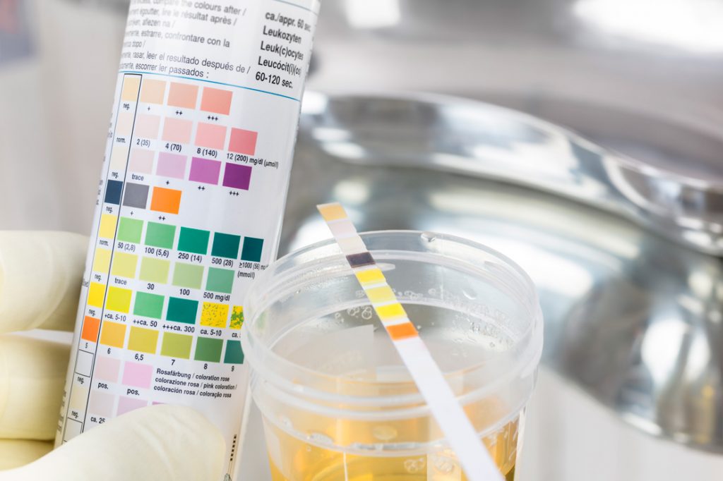 A gloved medical professional holding a sealed urine specimen cup in a clinical lab setting, realistic photography